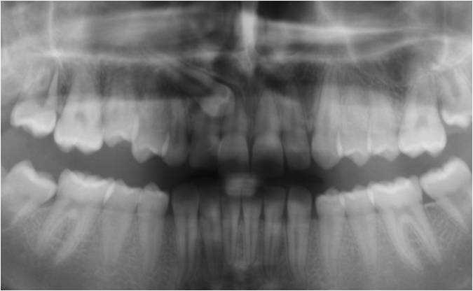 Røntgenbillede af tandsæt