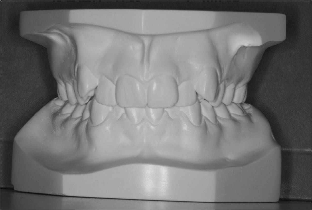 Gipsmodel af tandsæt
