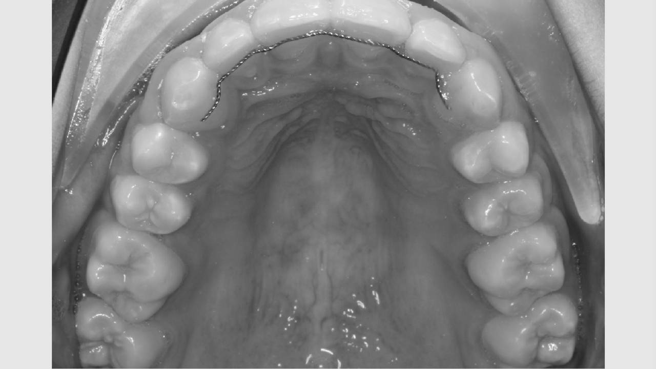 Tænder i overmund med retentionstråd
